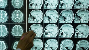 Har yili 11 million odam o‘ladi: JSST zudlik bilan miya salomatligiga e’tibor qaratishga chaqirdi